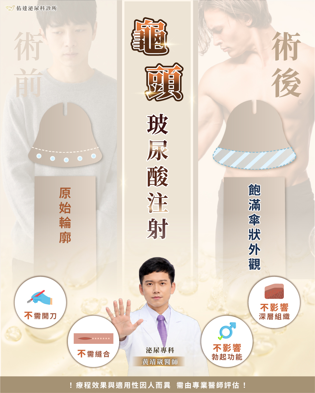 龜頭增大玻尿酸注射點位分布與注射層次示意圖