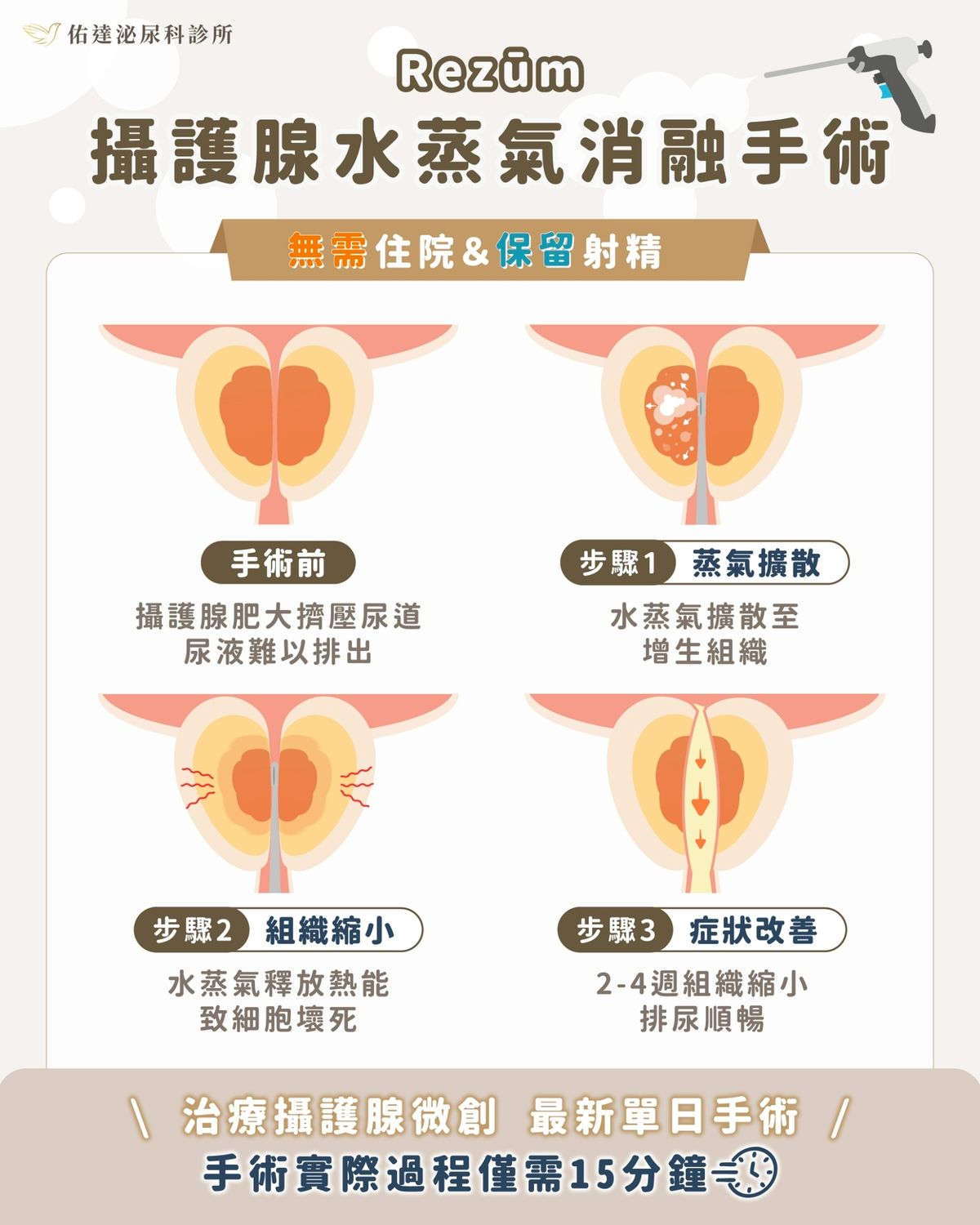 Rezum 攝護腺水蒸氣消融術 4 步驟原理 - 手術前、蒸氣擴散、組織縮小、症狀改善 - 佑達泌尿科